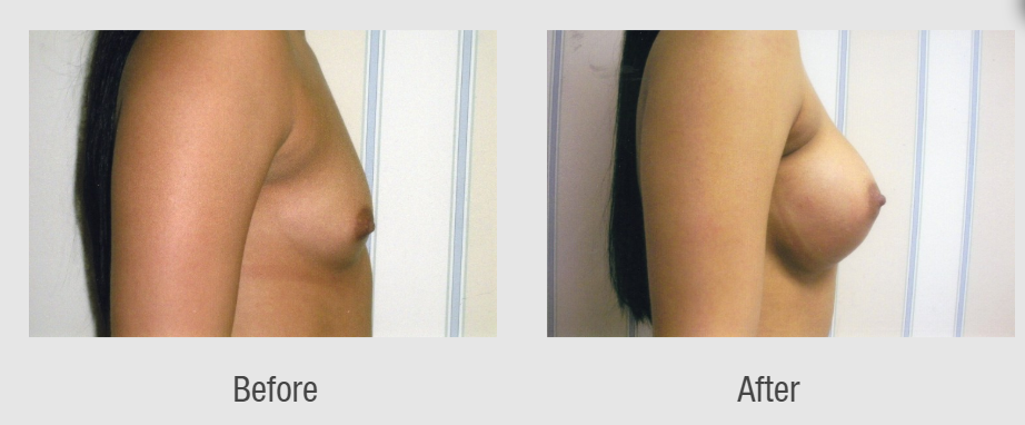 Photo of a patient before and after breast augmentation in Connecticut
